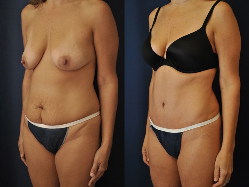 Tummy Tuck Before & After