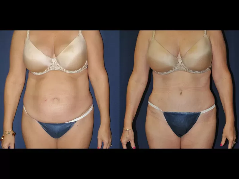 Tummy Tuck Before & After