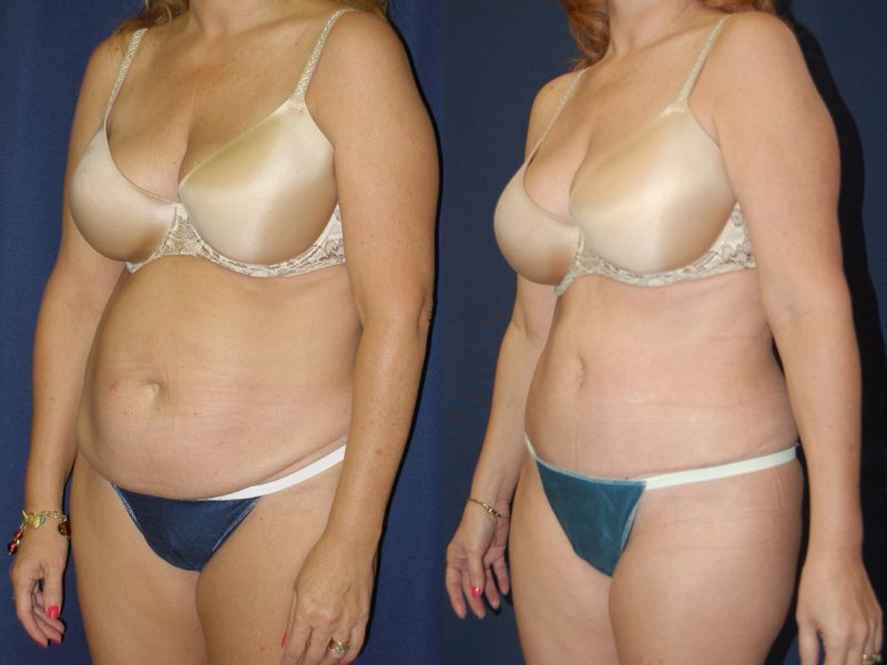 Tummy Tuck Before & After