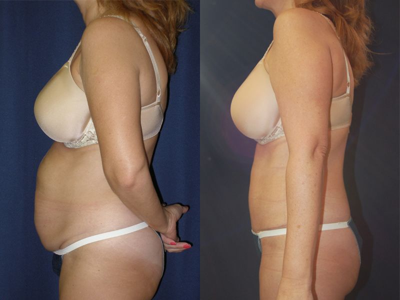 Tummy Tuck Before & After