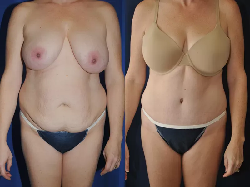 Tummy Tuck Before & After