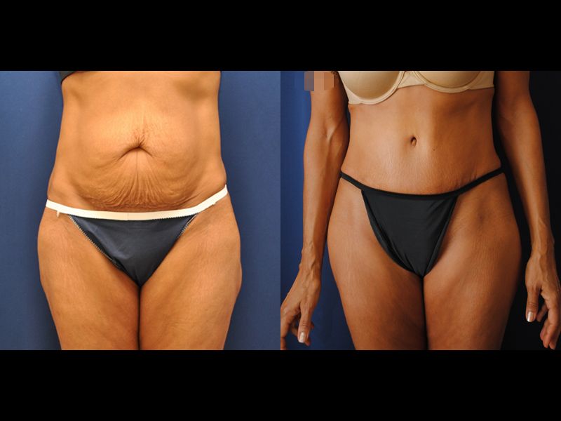 Tummy Tuck Before & After