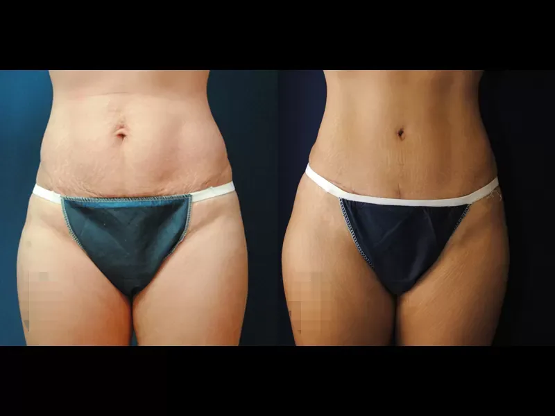 Tummy Tuck Before & After