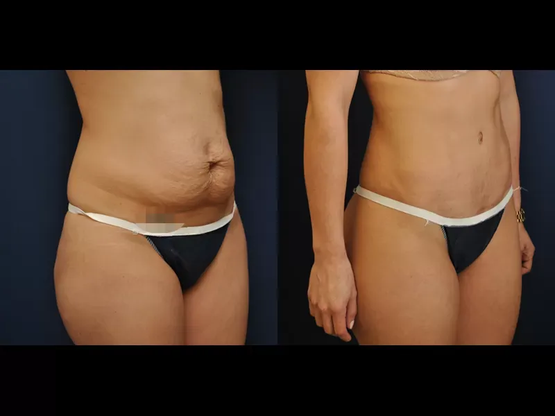 Tummy Tuck Before & After