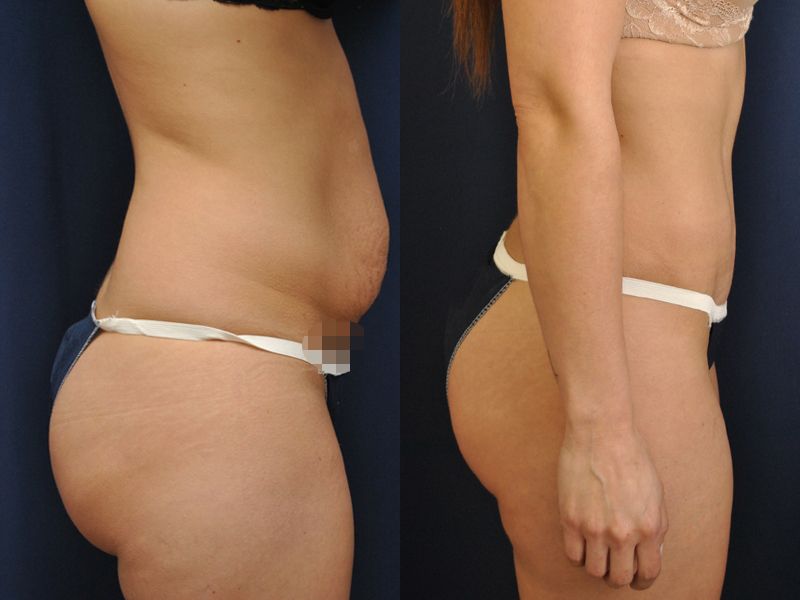 Tummy Tuck Before & After