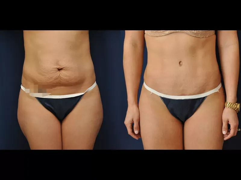 Tummy Tuck Before & After