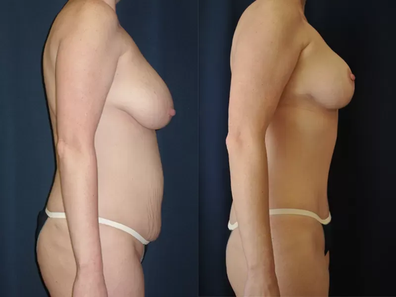 Tummy Tuck Before & After