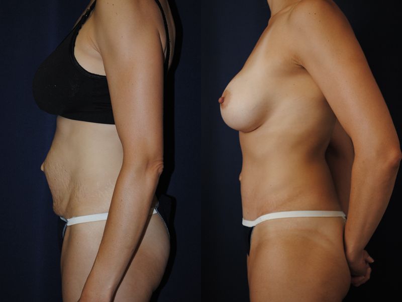 Tummy Tuck Before & After