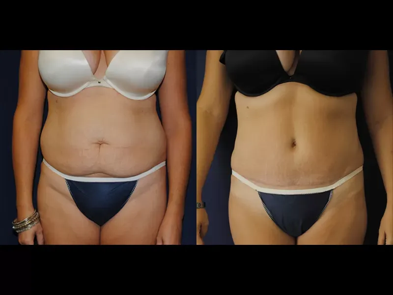 Tummy Tuck Before & After