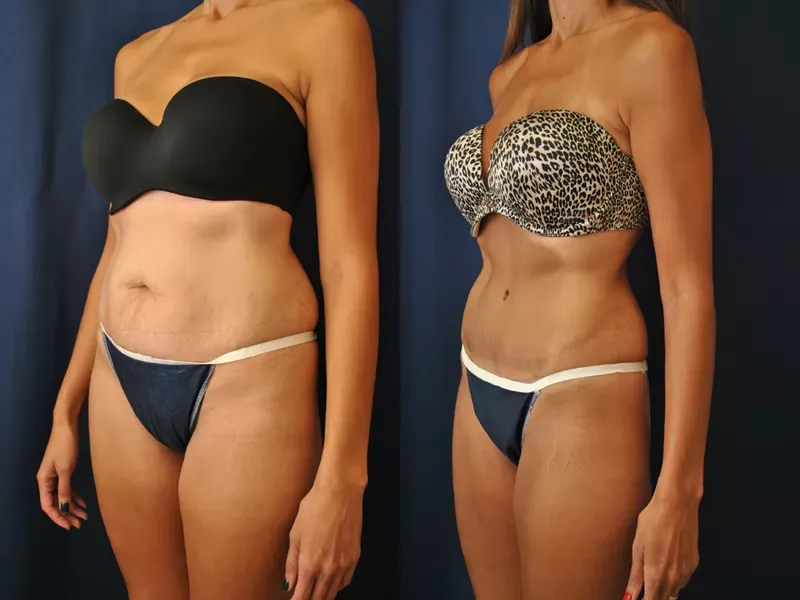 Tummy Tuck Before & After