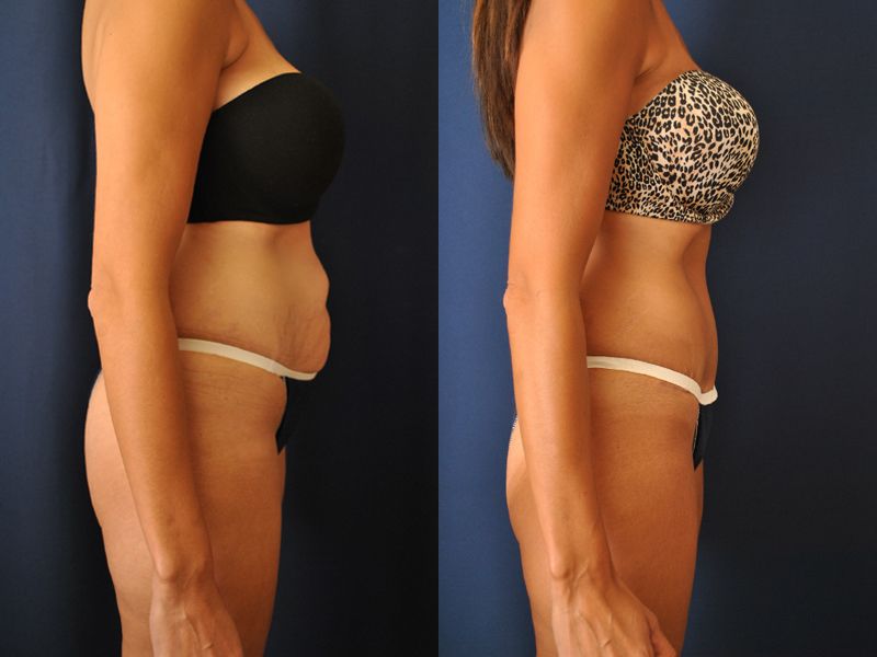 Tummy Tuck Before & After