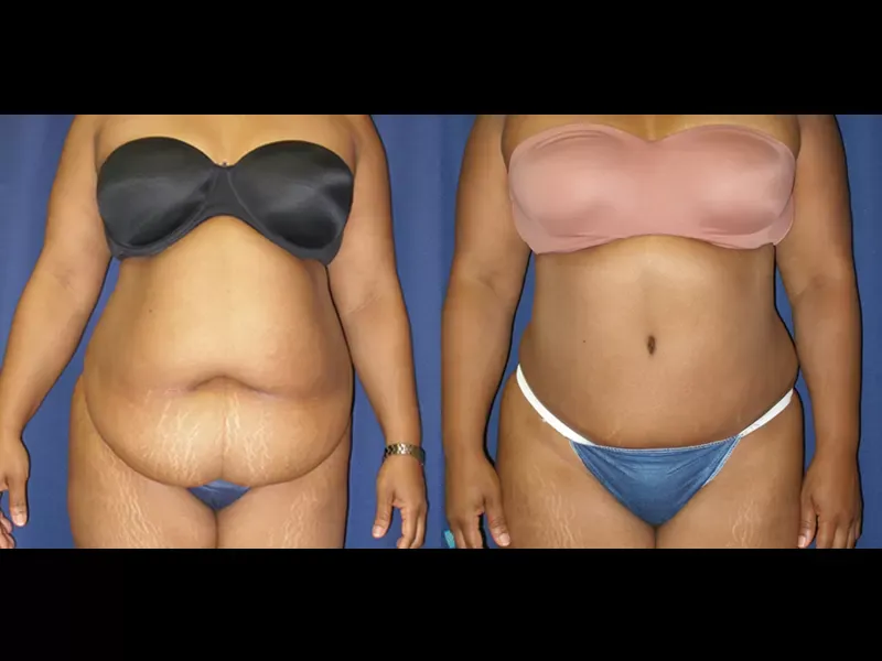 Tummy Tuck Before & After