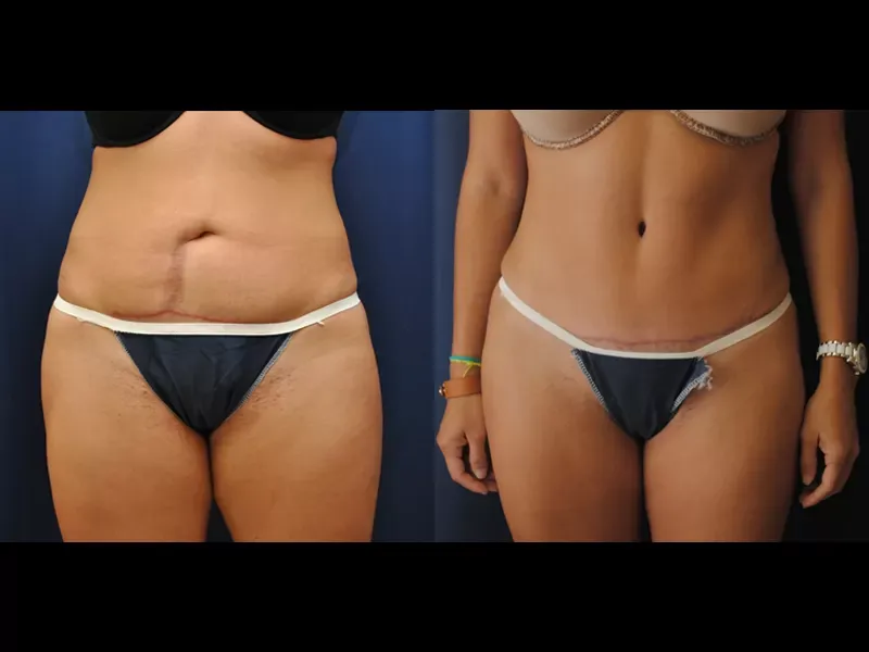 Tummy Tuck Before & After