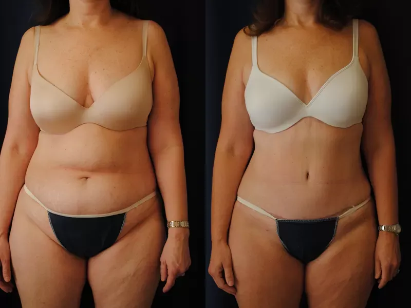 Tummy Tuck Before & After