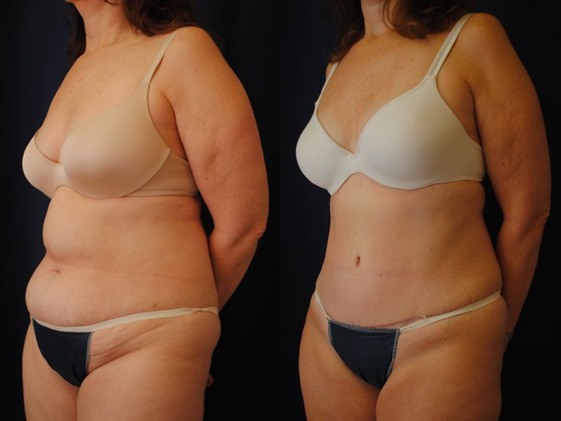 Tummy Tuck Before & After