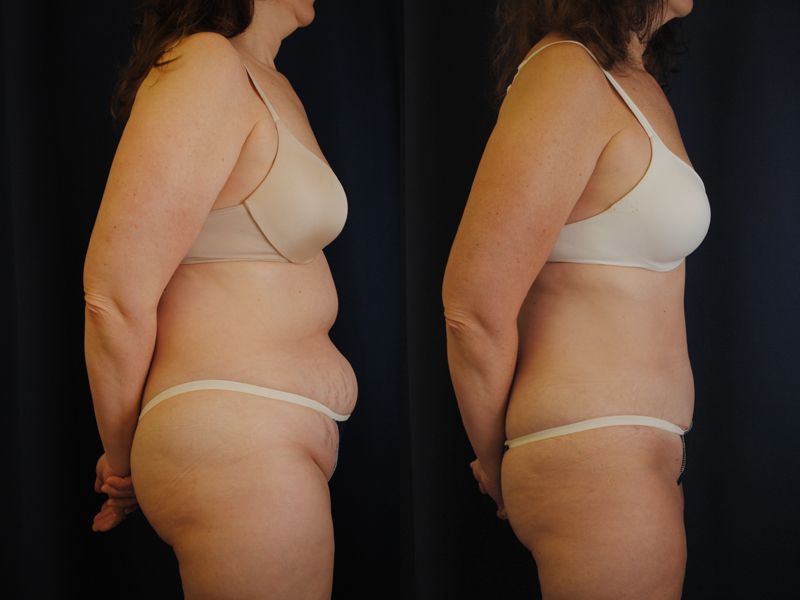 Tummy Tuck Before & After