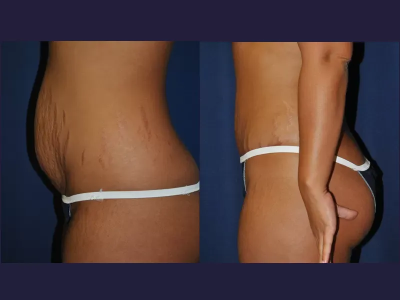 Tummy Tuck Before & After