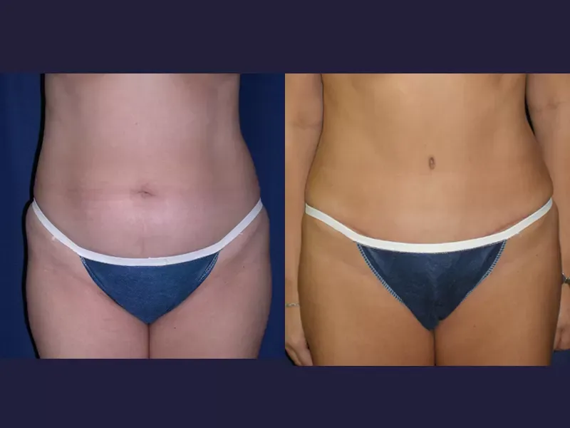 Tummy Tuck Before & After