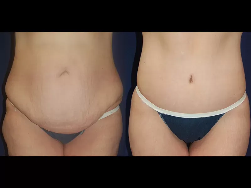 Tummy Tuck Before & After
