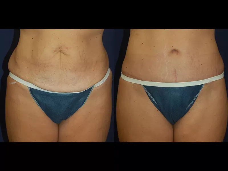 Tummy Tuck Before & After