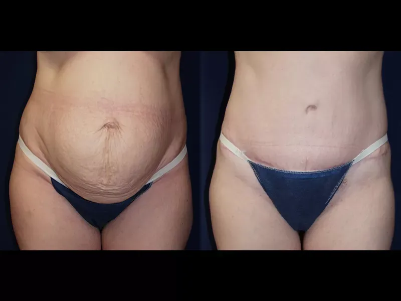 Tummy Tuck Before & After