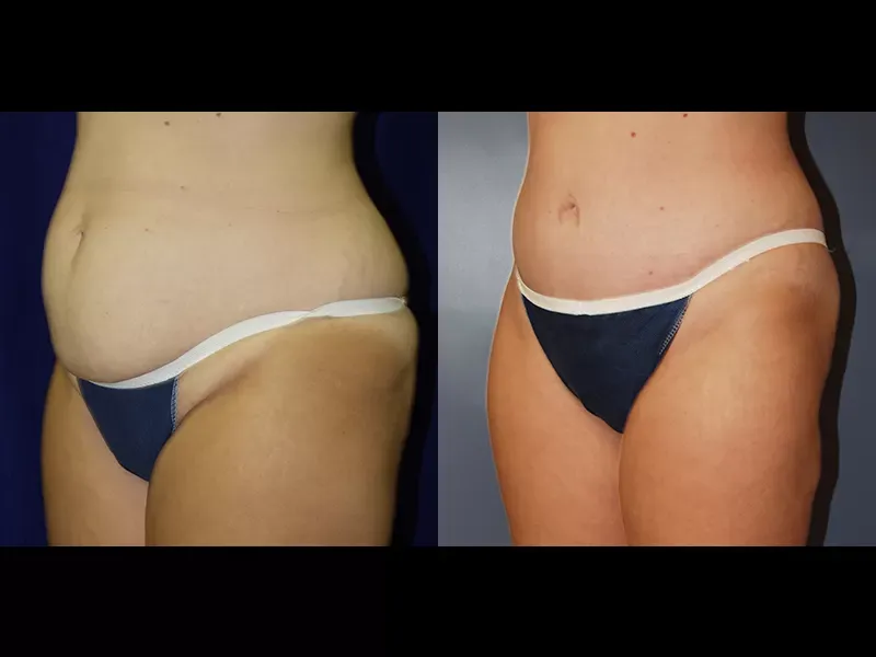 Tummy Tuck Before & After