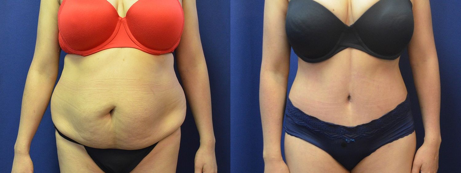 Tummy Tuck Before & After