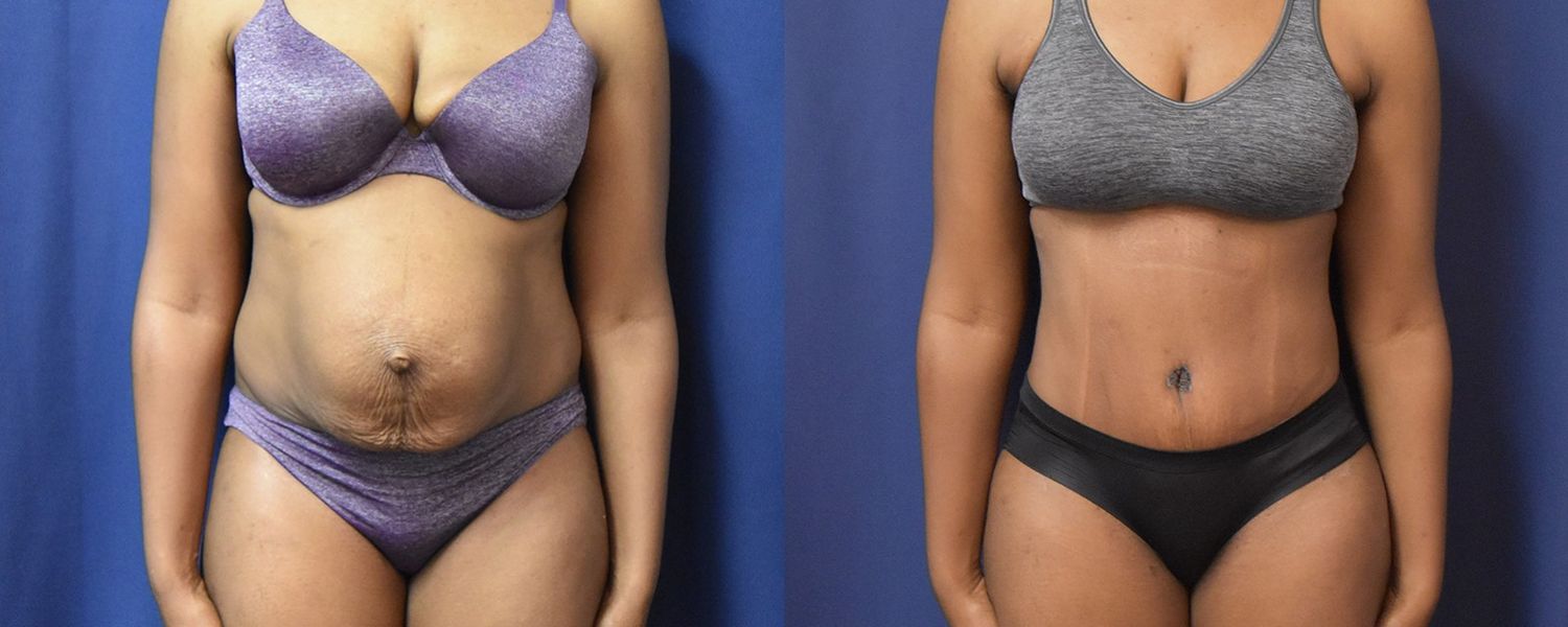Tummy Tuck Before & After