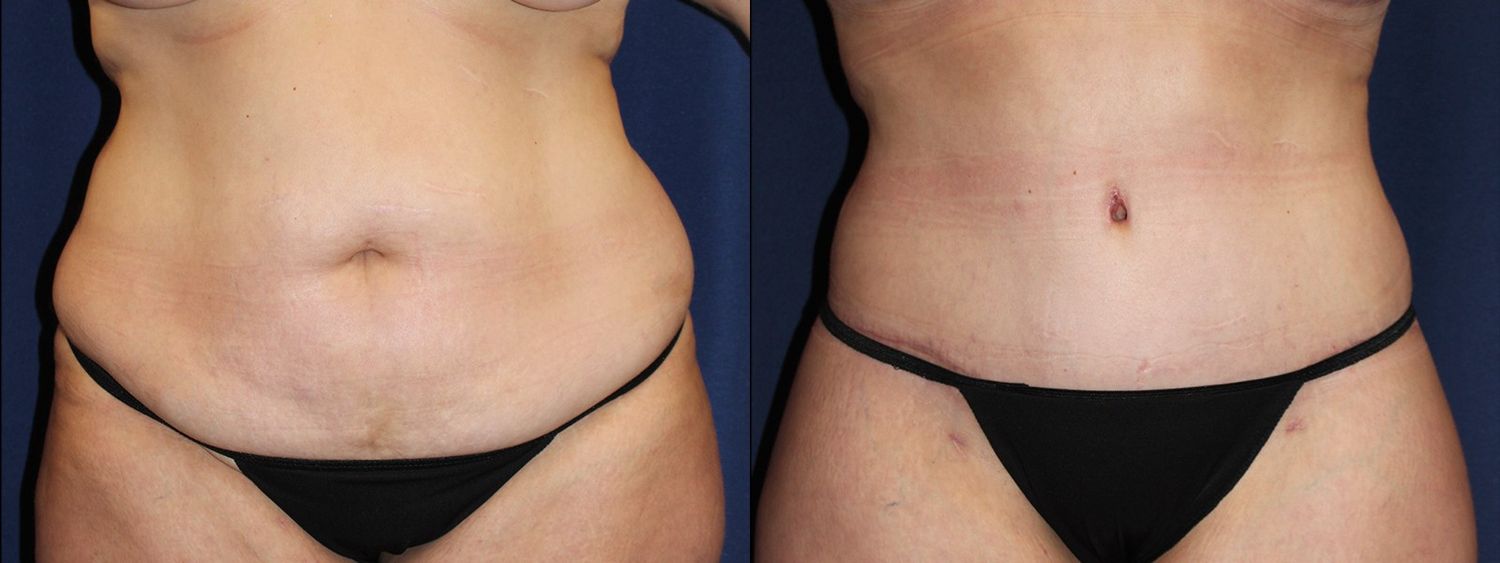 Tummy Tuck Before & After