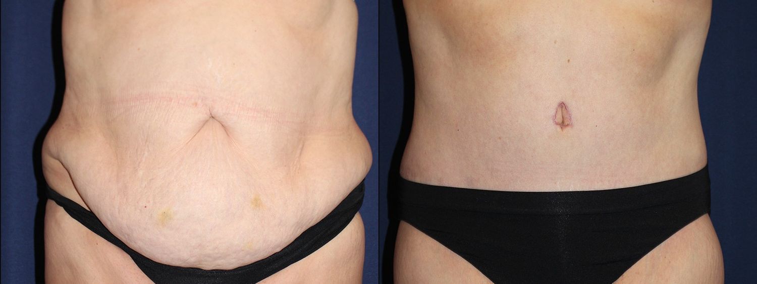 Tummy Tuck Before & After