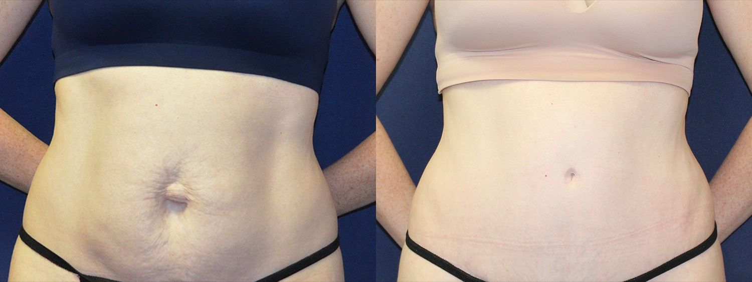 Tummy Tuck Before & After