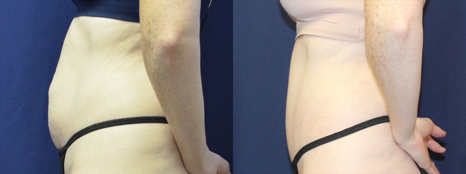 Tummy Tuck Before & After
