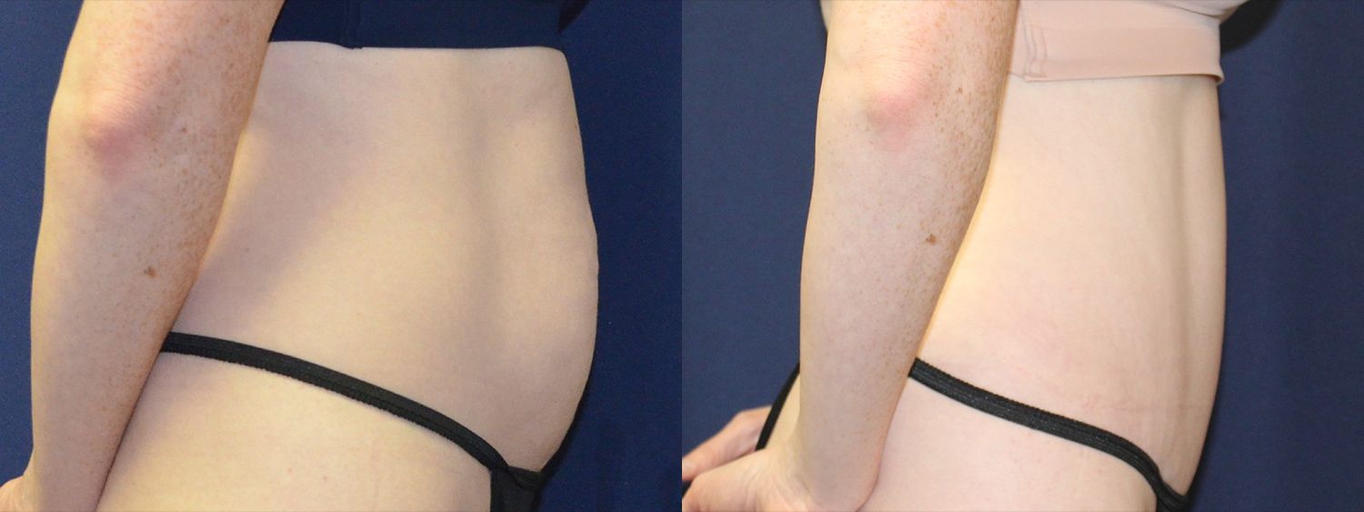 Tummy Tuck Before & After