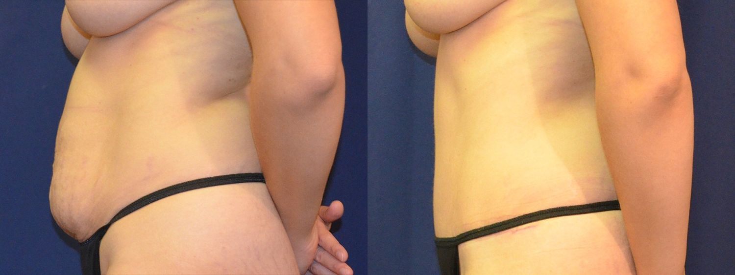 Tummy Tuck Before & After