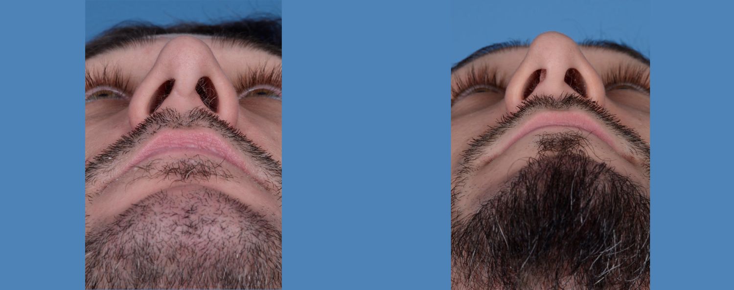 Rhinoplasty Before & After