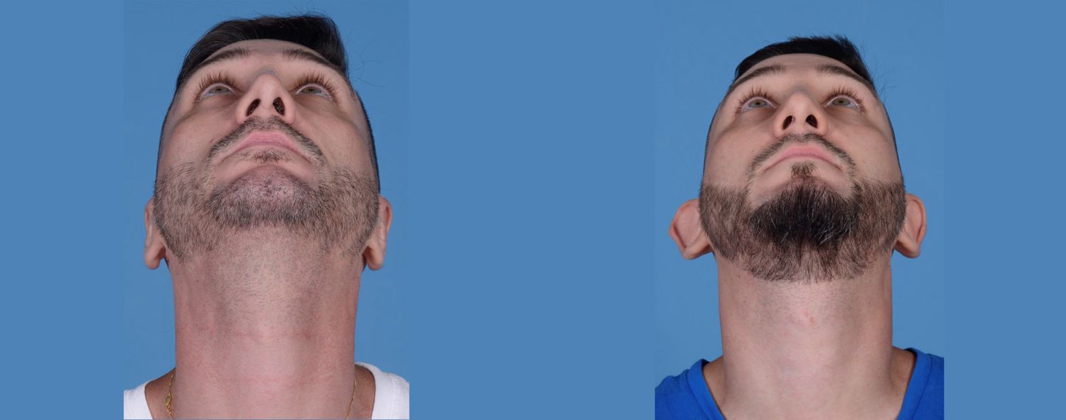 Rhinoplasty Before & After