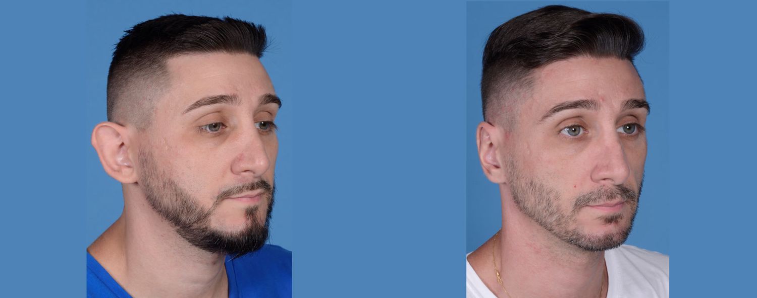 Rhinoplasty Before & After