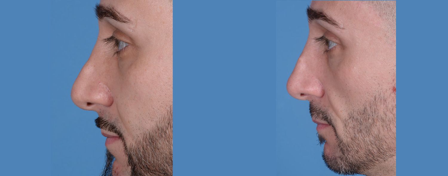 Rhinoplasty Before & After