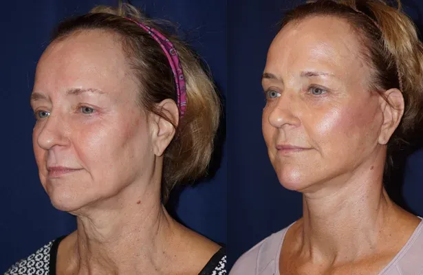 Facelift Before & After