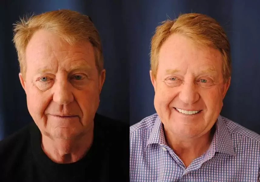 Facelift Before & After