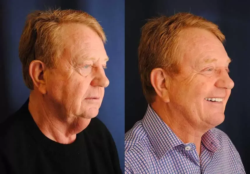 Facelift Before & After