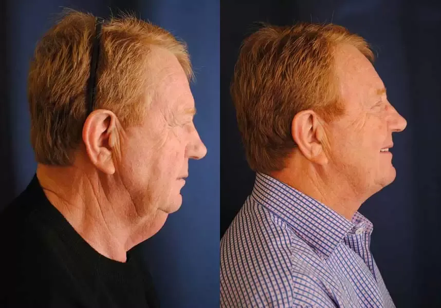 Facelift Before & After