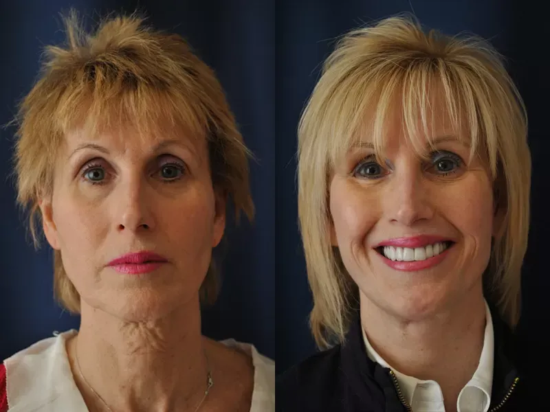 Facelift Before & After