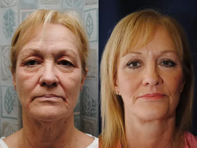 Facelift Before & After