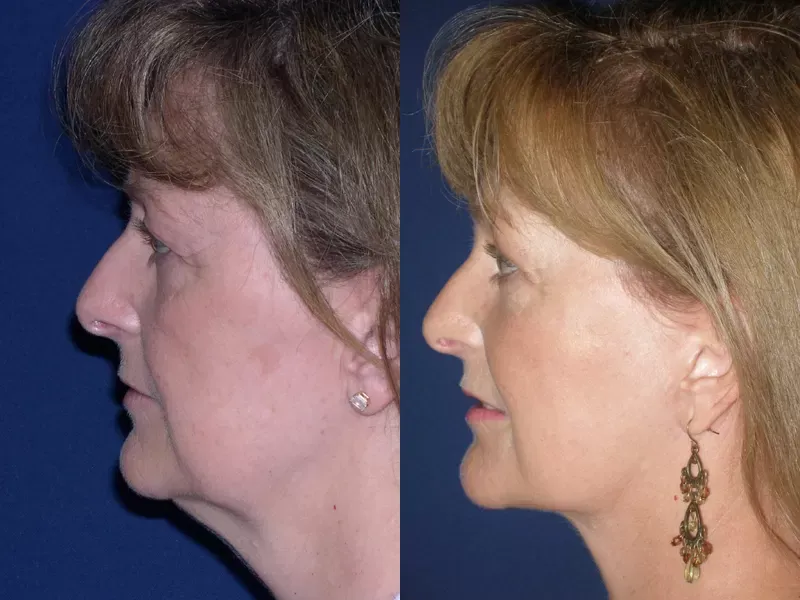 Facelift Before & After