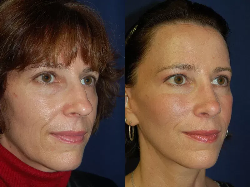 Facelift Before & After