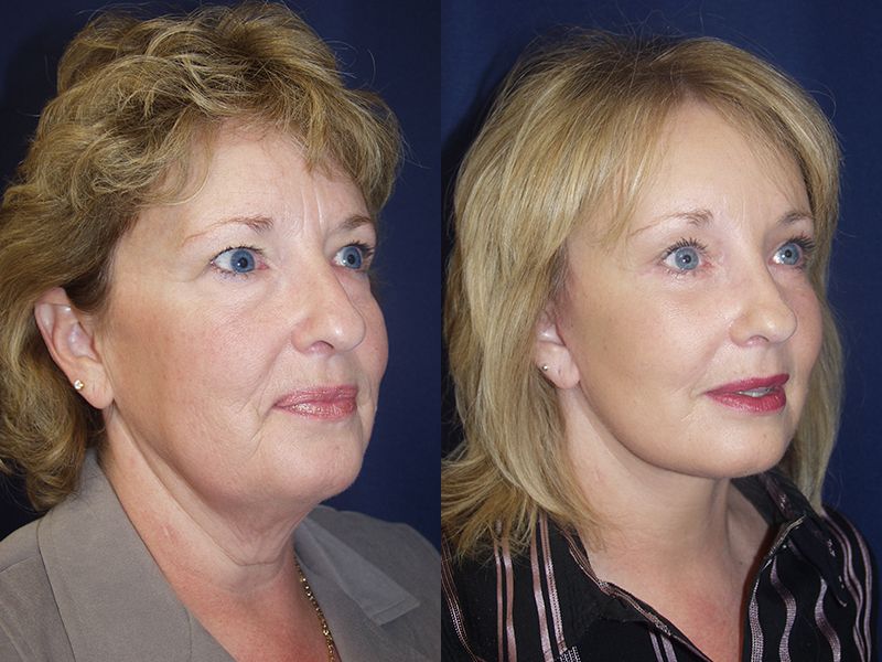 Facelift Before & After