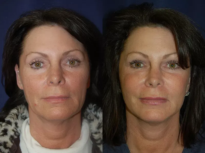 Facelift Before & After