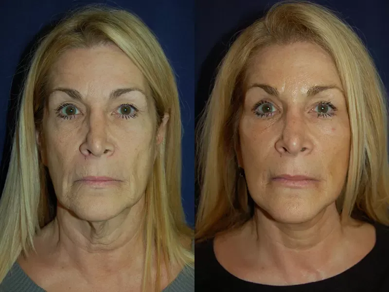 Facelift Before & After