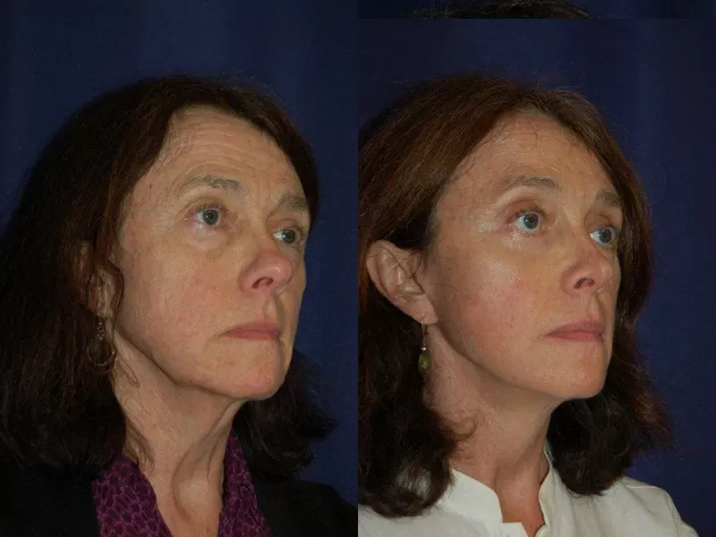 Facelift Before & After